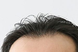 脂ぎってる頭皮にホホバオイルが効果的な理由